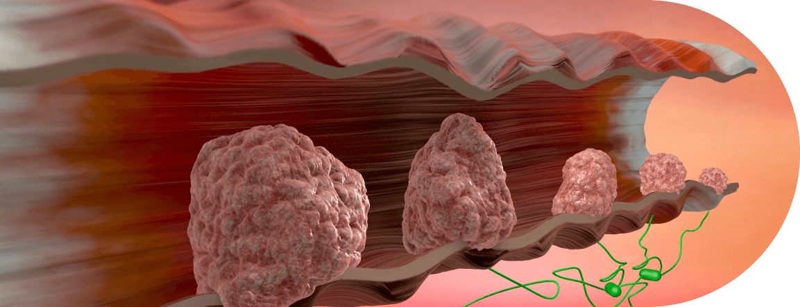 imagem-interna-câncer-de-intestino-daniel-musse