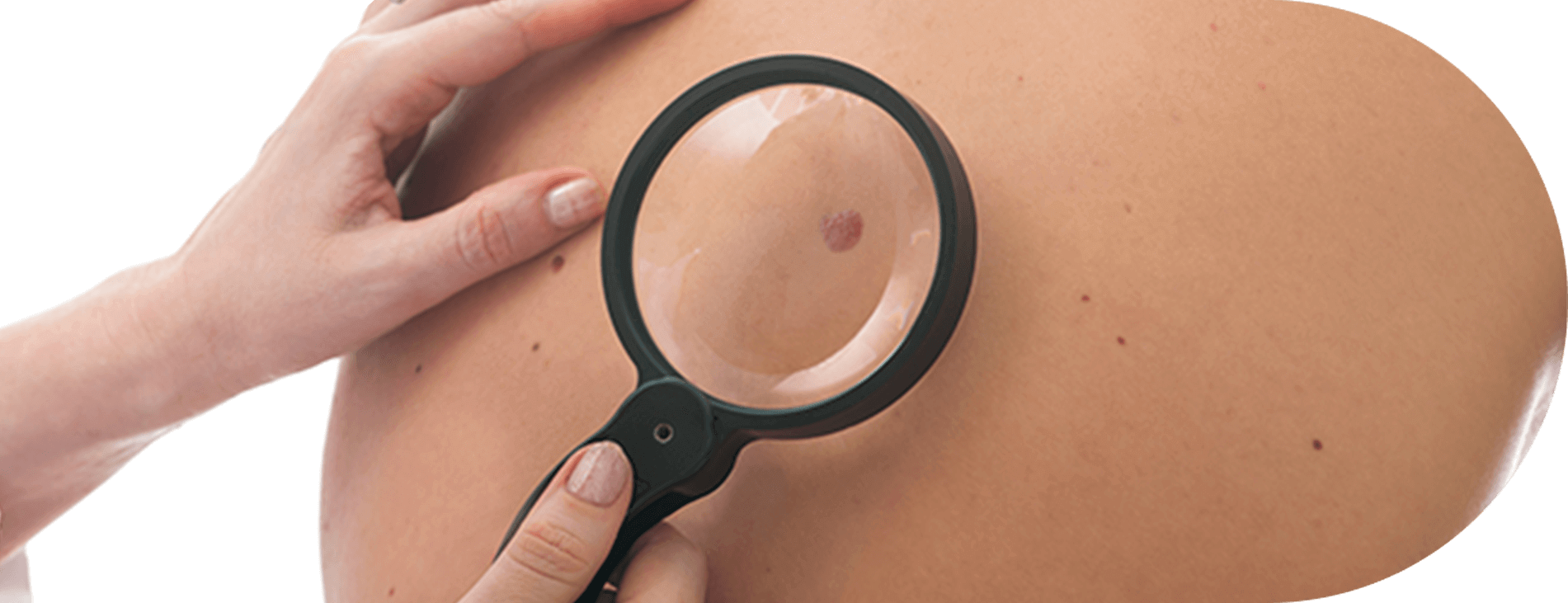 imagem-interna-cancer-de-pele-daniel-musse