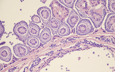 Adenocarcinoma endometrioide: guia completo sobre diagnóstico e tratamento