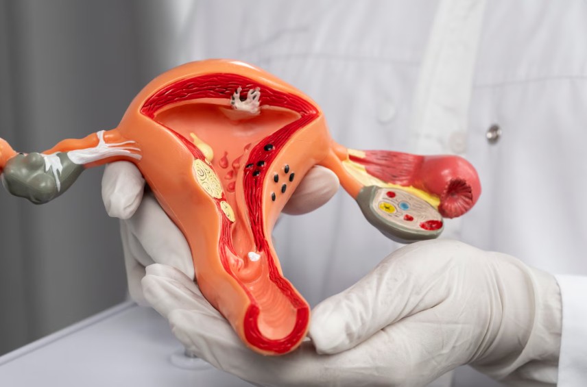 Câncer de útero: entenda as diferenças entre câncer de endométrio e câncer do colo uterino — Como cada tumor é investigado e tratado