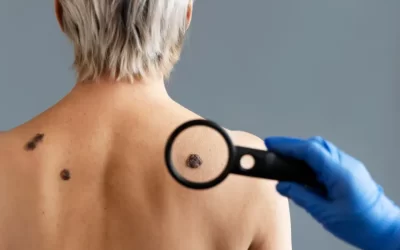 Carcinoma epidermoide: entenda essa forma comum de câncer e como tratá-la com segurança