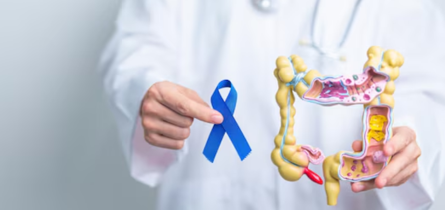 Tratamentos para câncer colorretal: entenda as opções e avanços da medicina