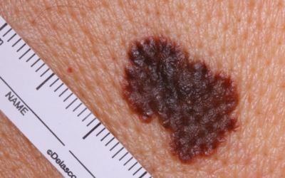 Melanoma: Sinais de alerta, diagnóstico e tratamentos modernos
