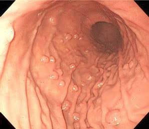 Pólipo gástrico é câncer? Saiba por que a biópsia pode ser importante para definir o diagnóstico — Quando o oncologista entra no cuidado?
