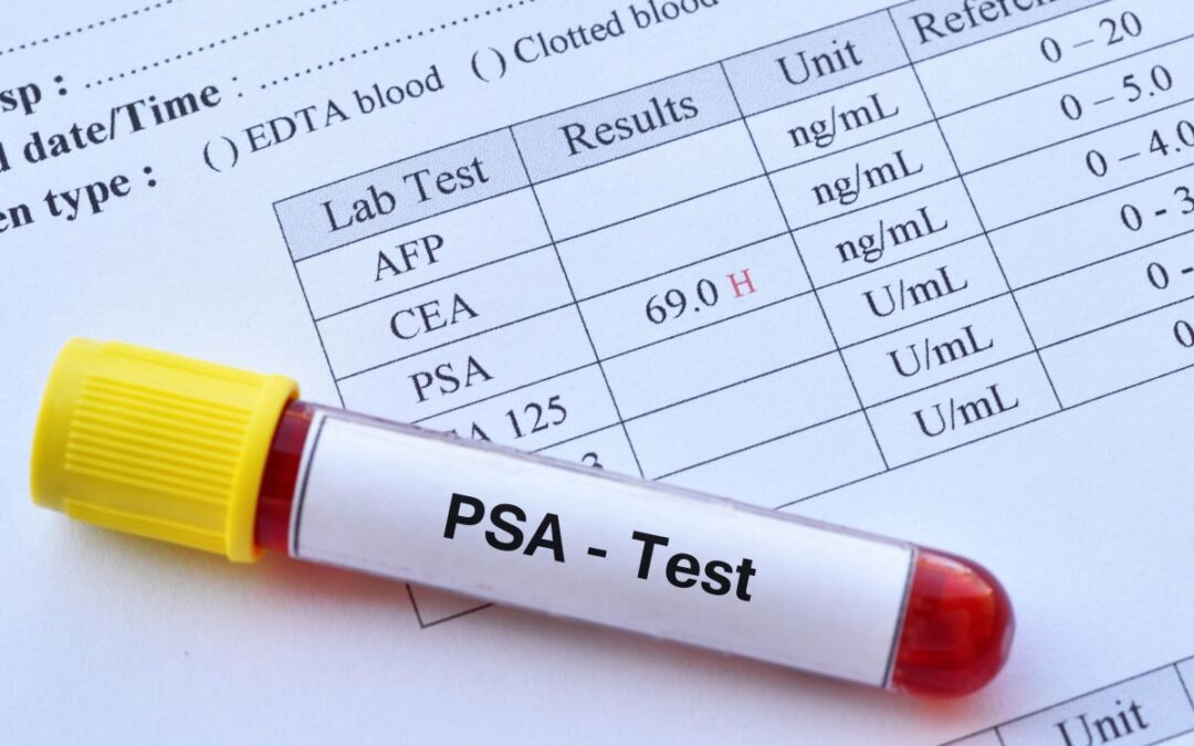 PSA alterado significa câncer? Entenda o que pode causar mudanças no exame