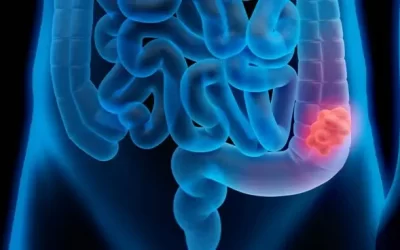 Tumor de cólon direito: sintomas, diagnóstico e a importância de ouvir o corpo